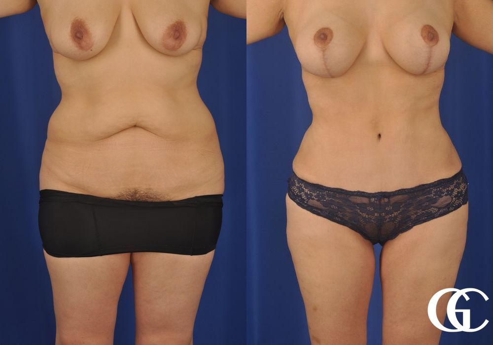 Liposuction - Case 6952