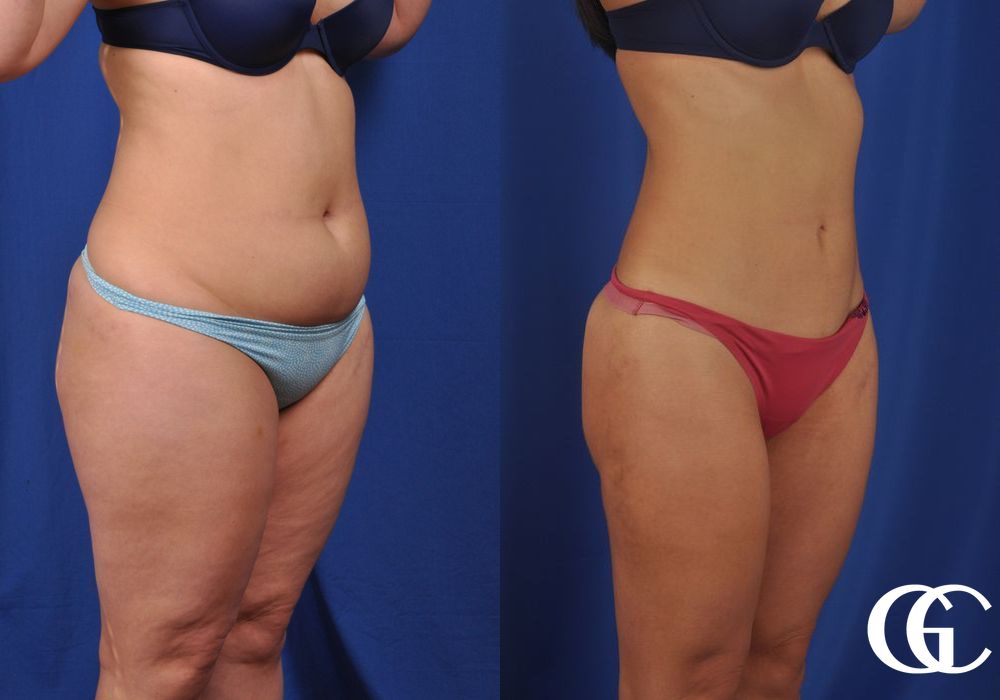 Liposuction - Thumbnail 2