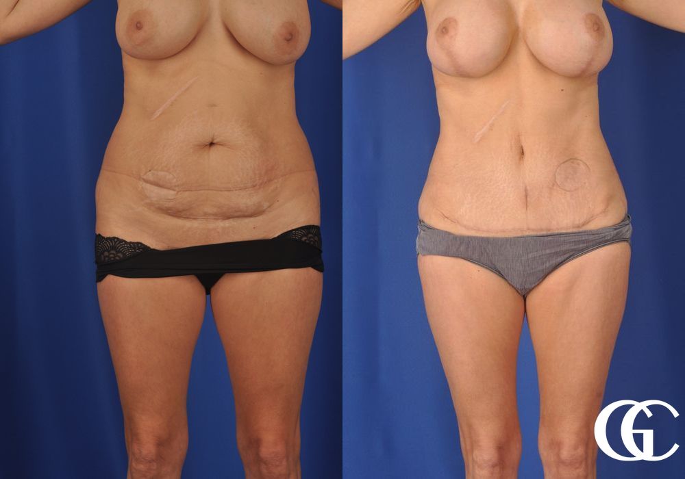 Liposuction - Case 6958