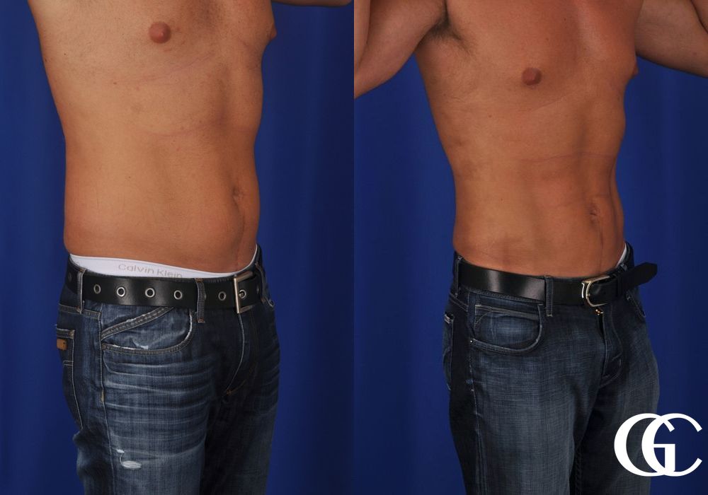 Liposuction - Thumbnail 2