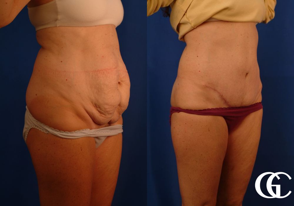Liposuction - Thumbnail 2