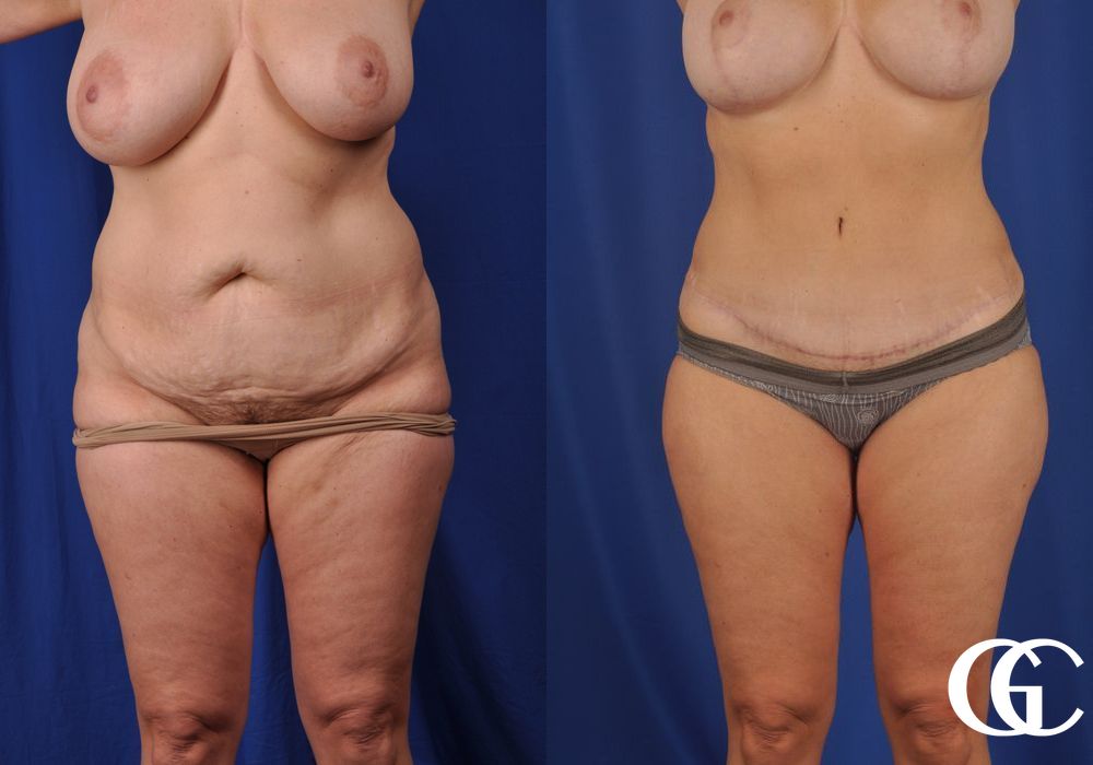 Liposuction - Case 6951