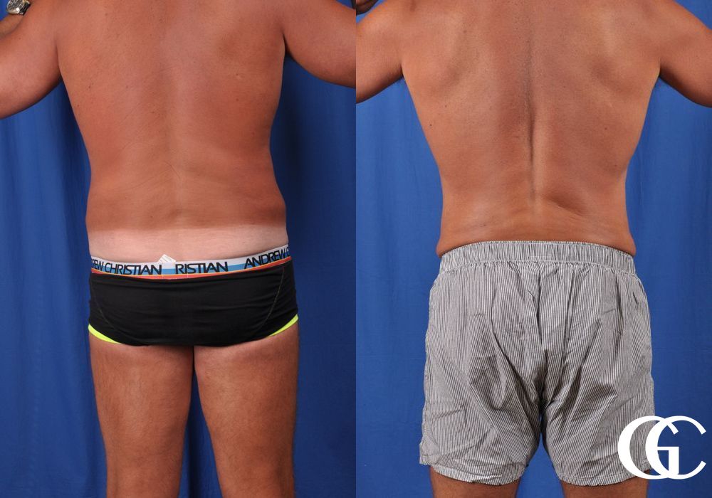 Liposuction - Thumbnail 4