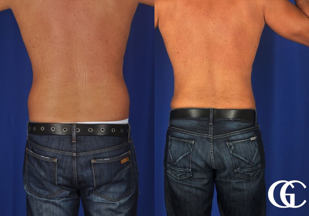 Liposuction - Thumbnail 4