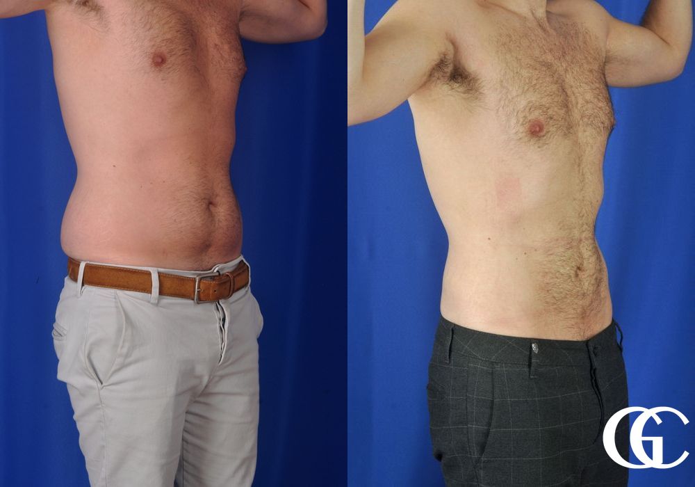 Liposuction - Thumbnail 2