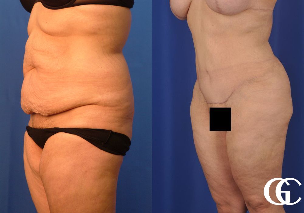 Liposuction - Thumbnail 4