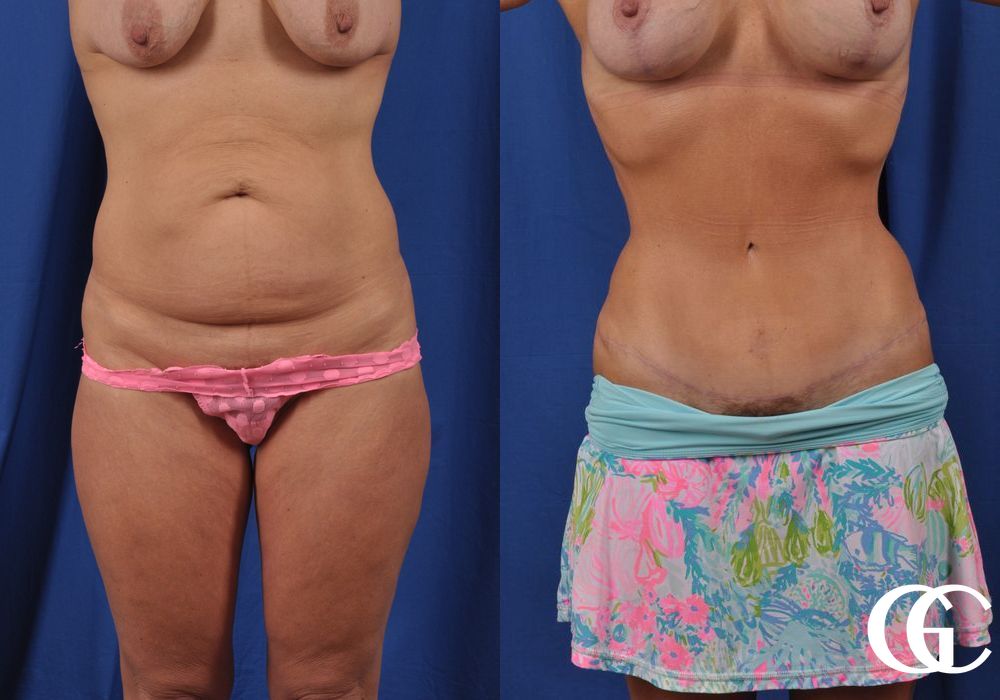 Liposuction - Thumbnail 2