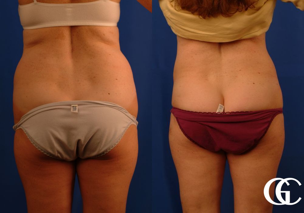 Liposuction - Thumbnail 4