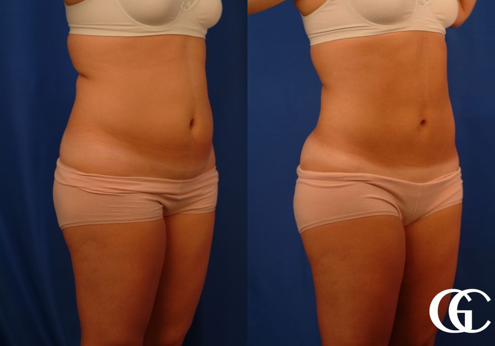 Liposuction - Thumbnail 2