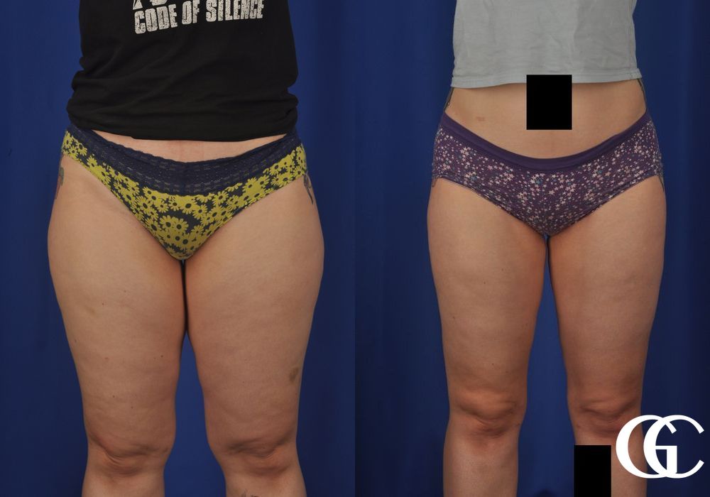 Liposuction - Thumbnail 4