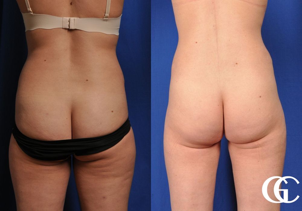 Tummy Tuck - Thumbnail 5