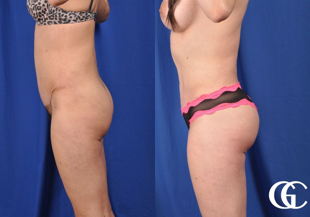 Liposuction - Thumbnail 2