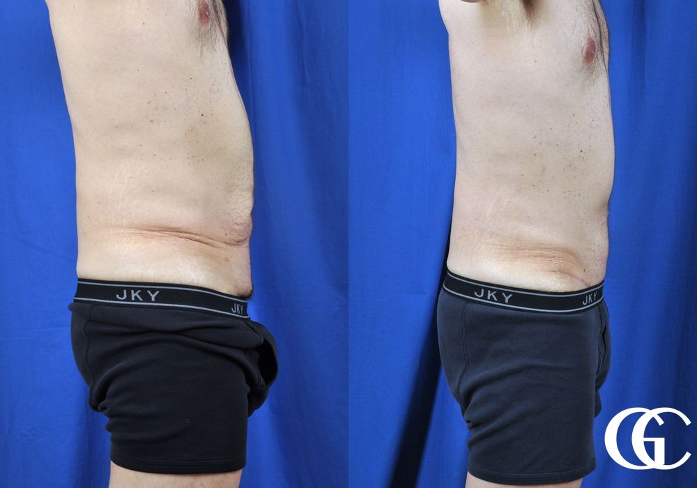 Liposuction - Thumbnail 3