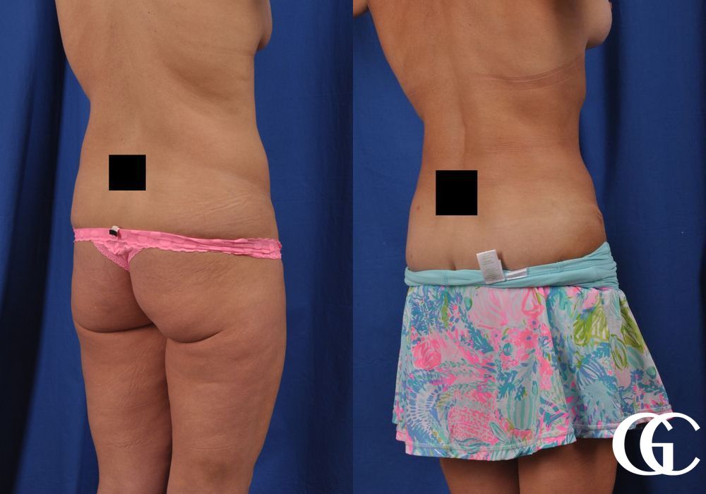 Liposuction - Thumbnail 4