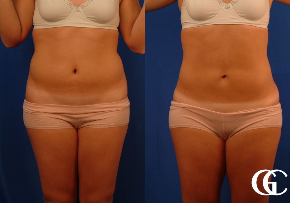 Liposuction - Case 6932