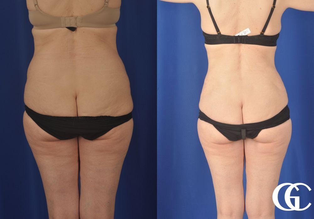 Liposuction - Thumbnail 5