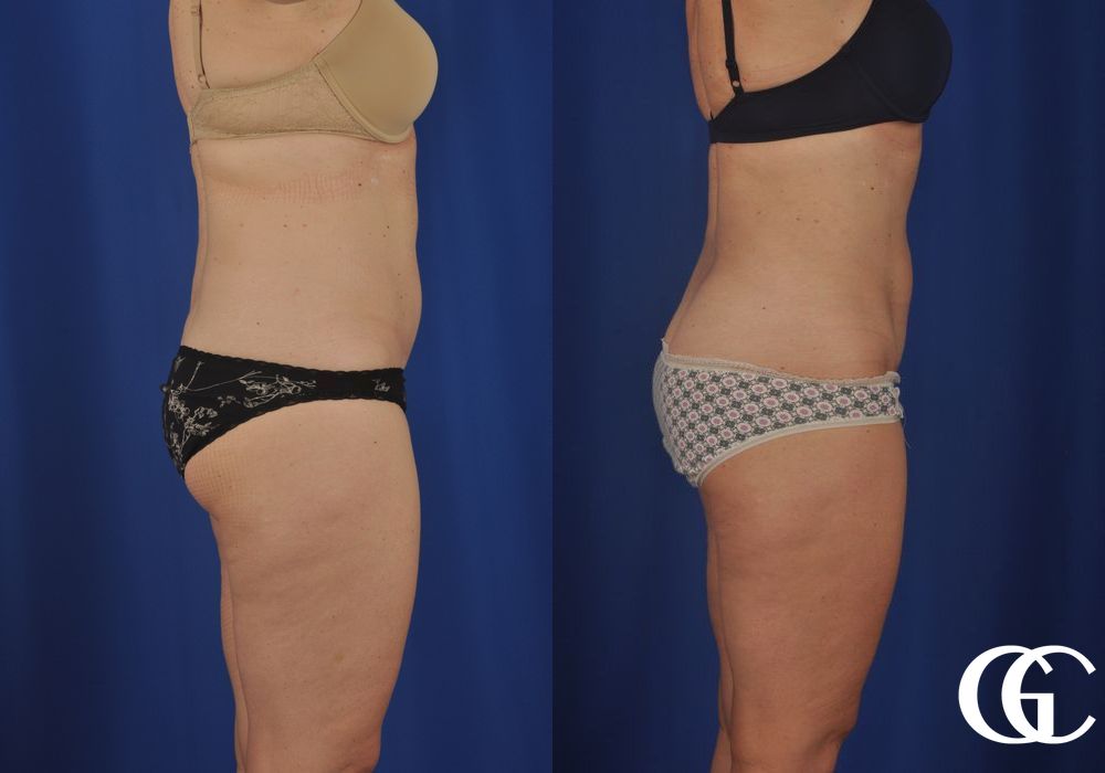 Liposuction - Thumbnail 3