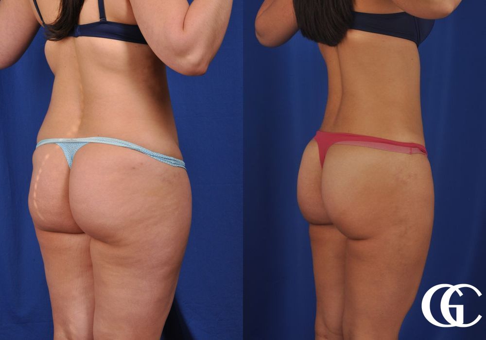 Liposuction - Thumbnail 4