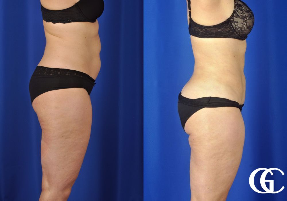 Liposuction - Thumbnail 4