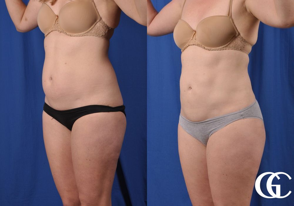 Liposuction - Thumbnail 5