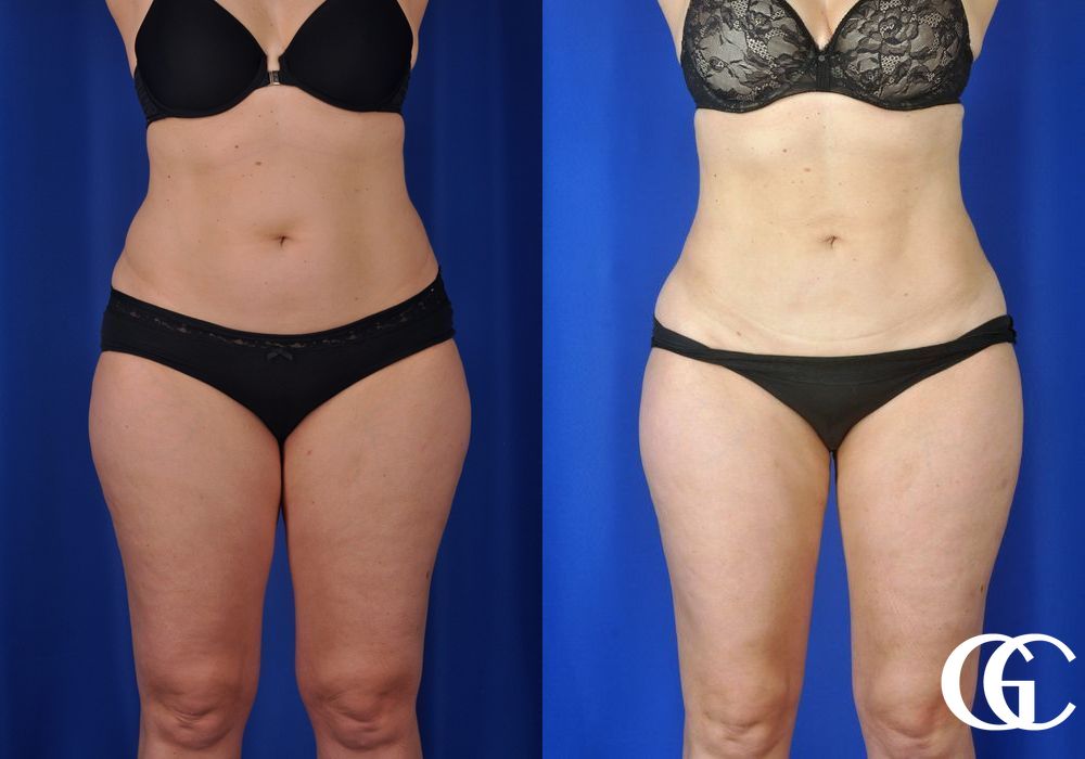 Liposuction - Thumbnail 2