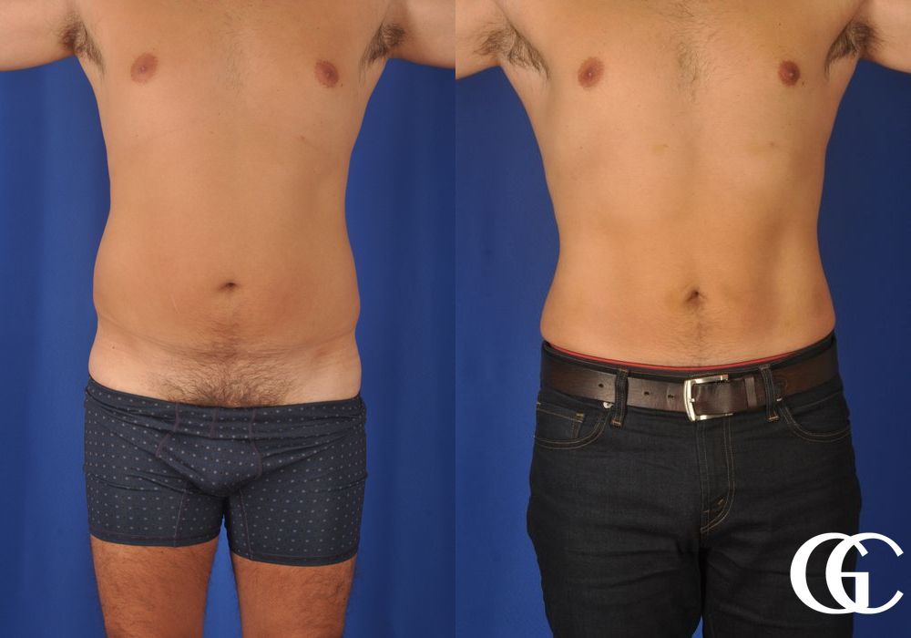 Liposuction - Case 6956