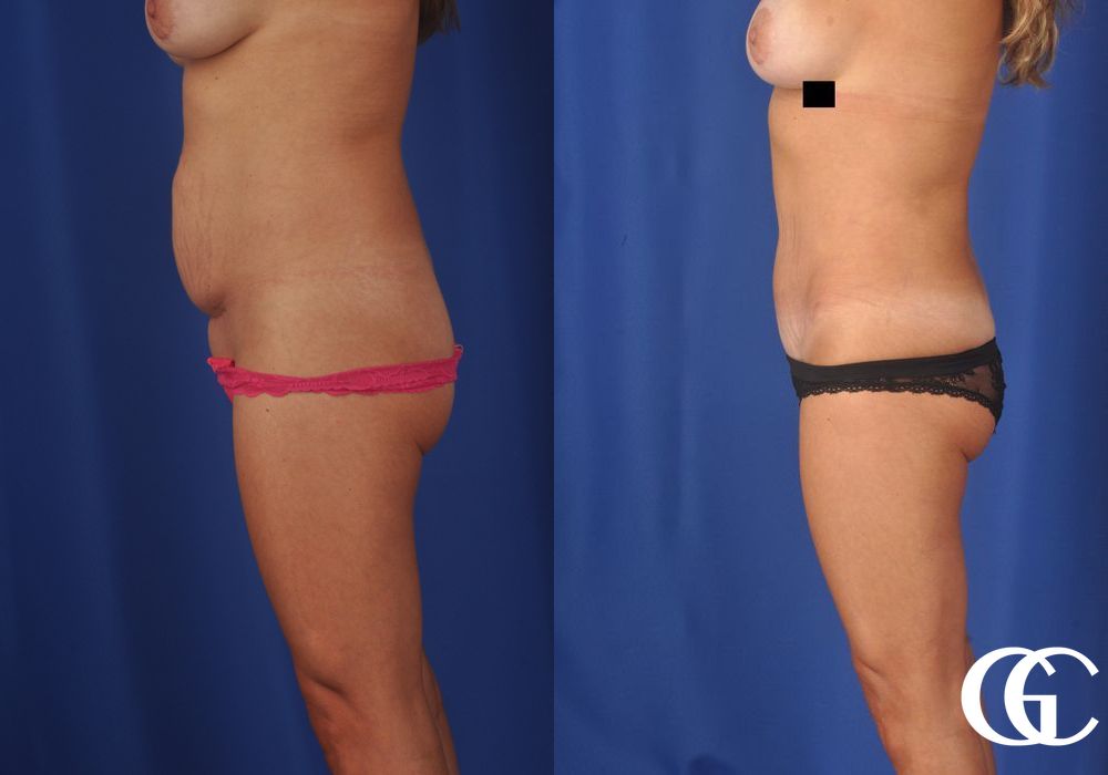 Liposuction - Thumbnail 3