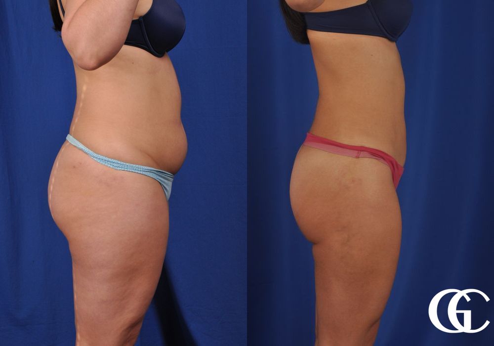 Liposuction - Thumbnail 3