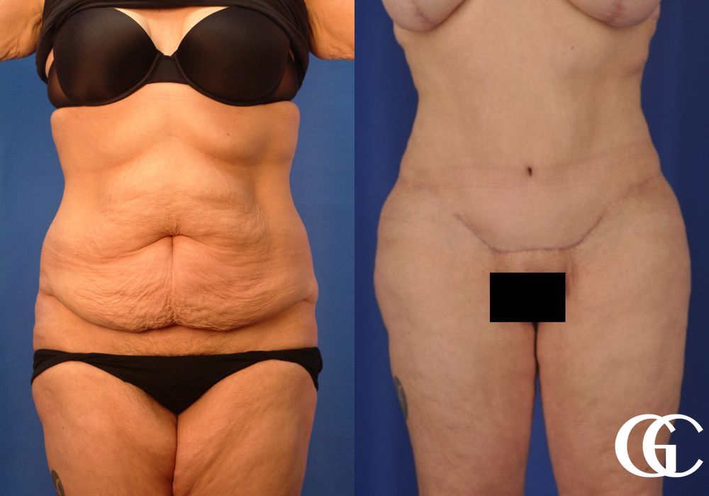 Liposuction - Thumbnail 3