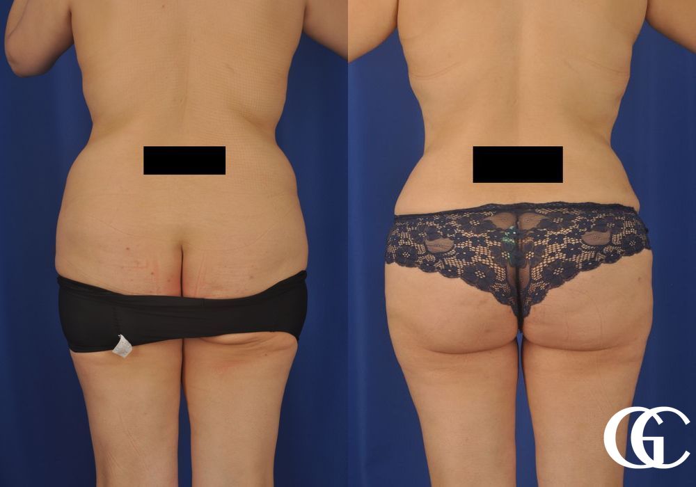 Liposuction - Thumbnail 2