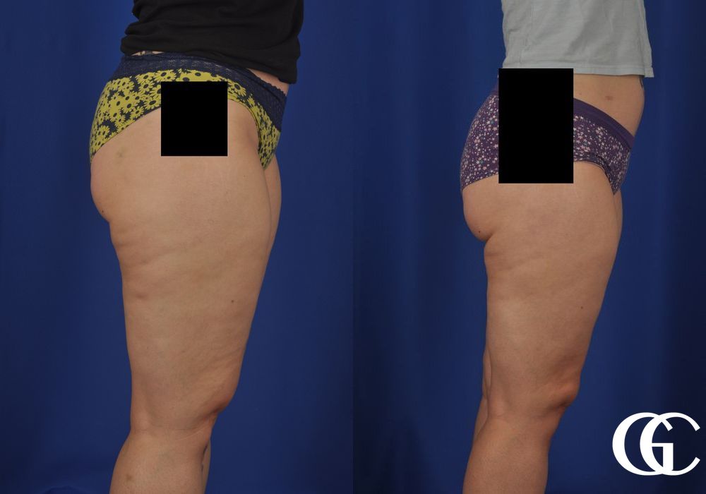 Liposuction - Thumbnail 2