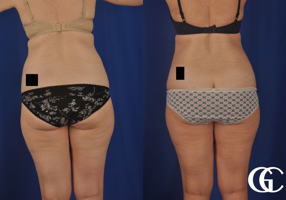 Liposuction - Thumbnail 4