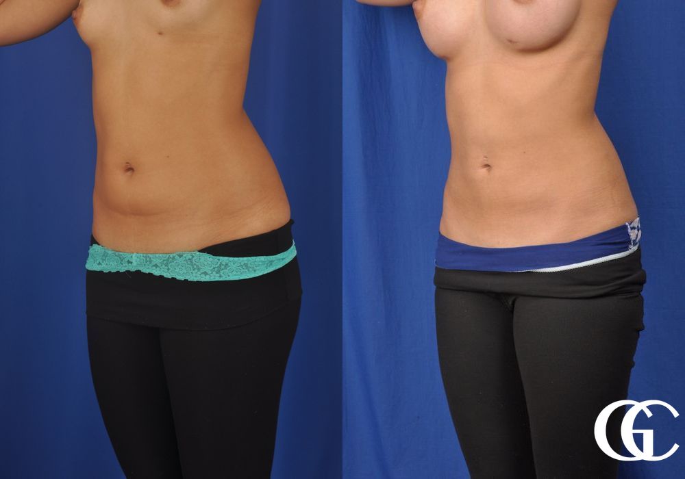 Liposuction - Thumbnail 2