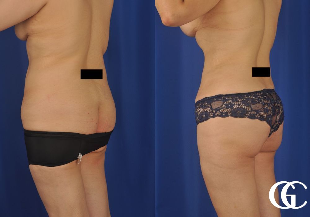 Liposuction - Thumbnail 3