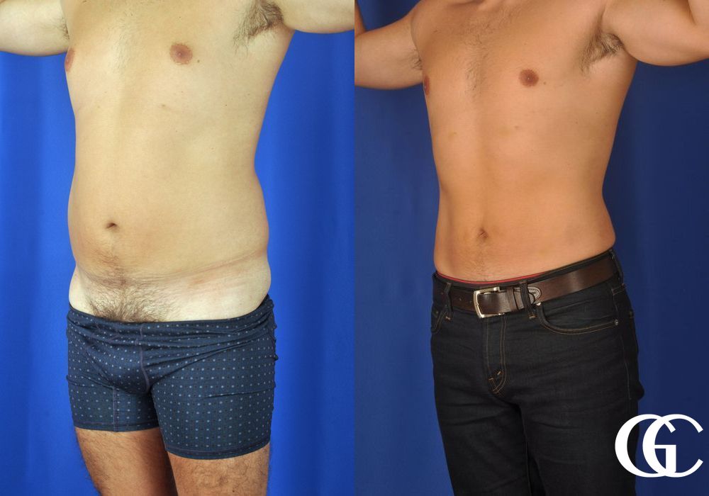 Liposuction - Thumbnail 4