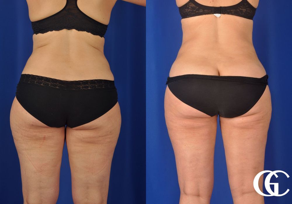 Liposuction - Case 6921