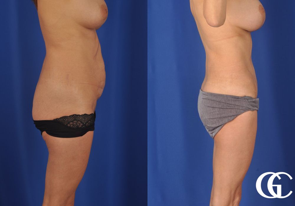 Liposuction - Thumbnail 3