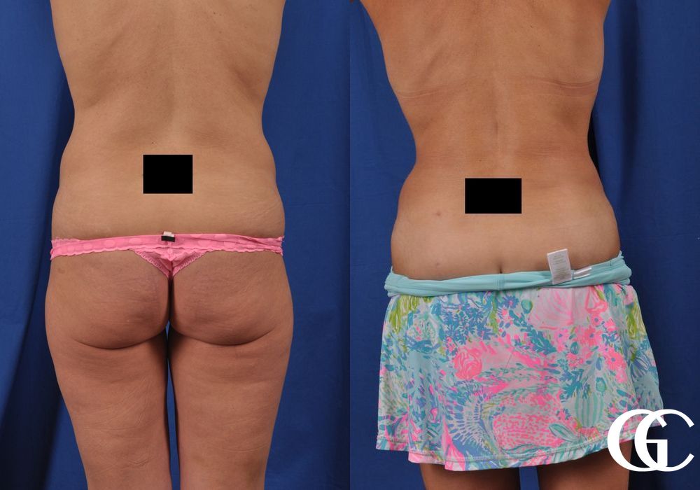 Liposuction - Thumbnail 3