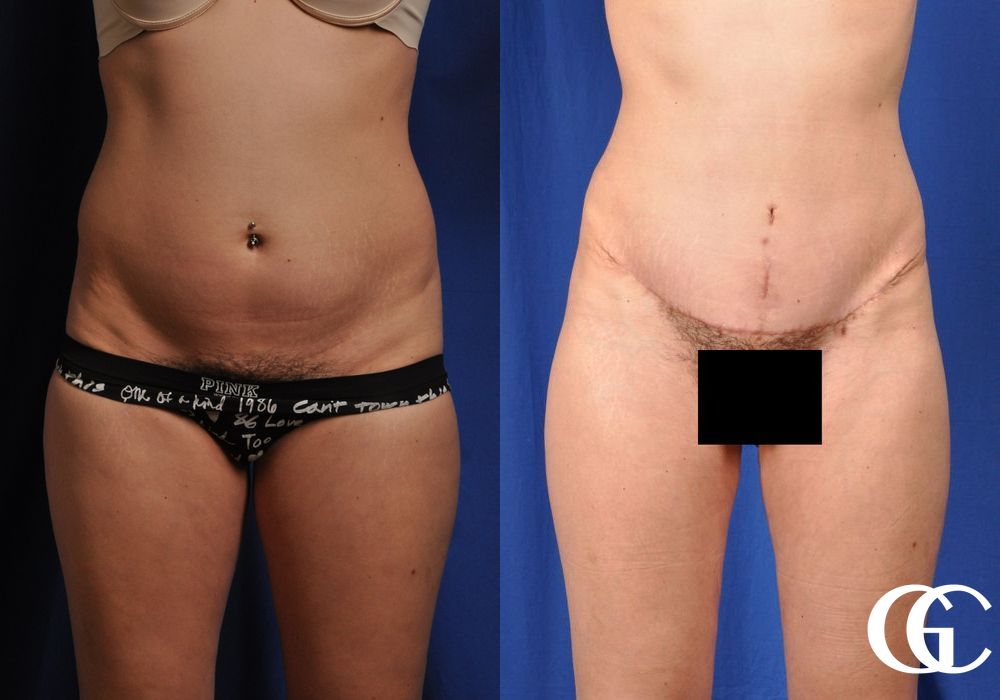 Tummy Tuck - Case 6986
