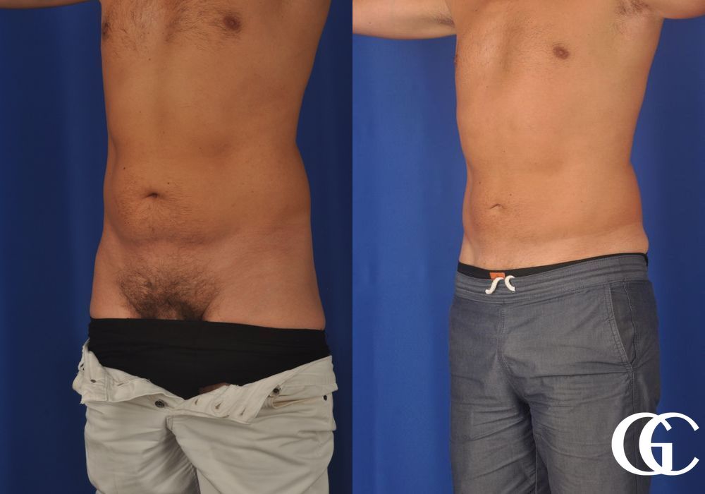 Liposuction for Men - Thumbnail 3