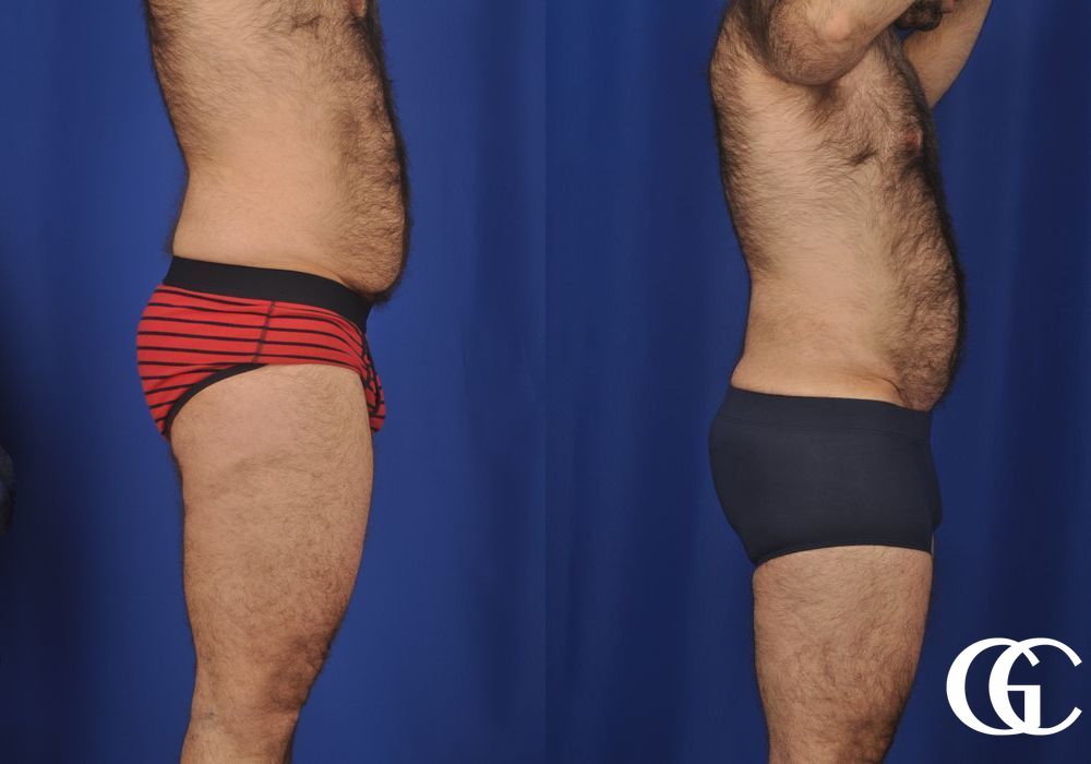 Liposuction for Men - Thumbnail 3