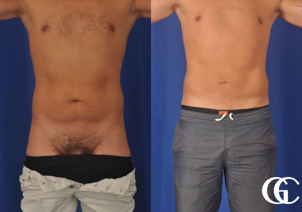 Liposuction for Men - Thumbnail 2