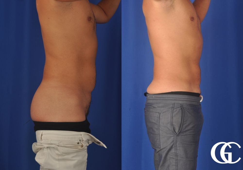 Liposuction for Men - Thumbnail 4