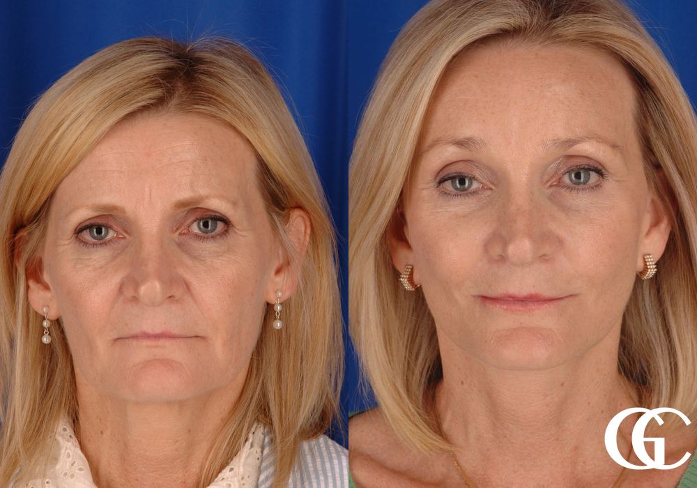 Neck Lift - Case 7420