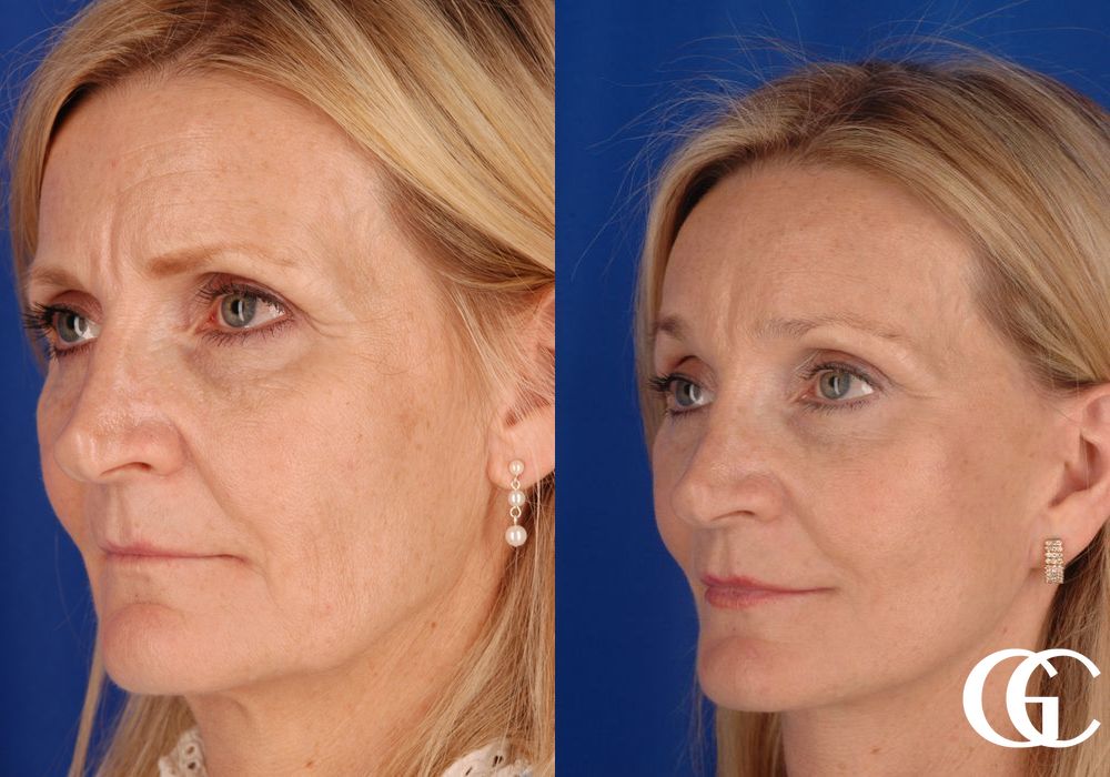 Neck Lift - Thumbnail 2