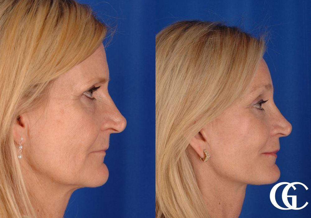 Neck Lift - Thumbnail 3