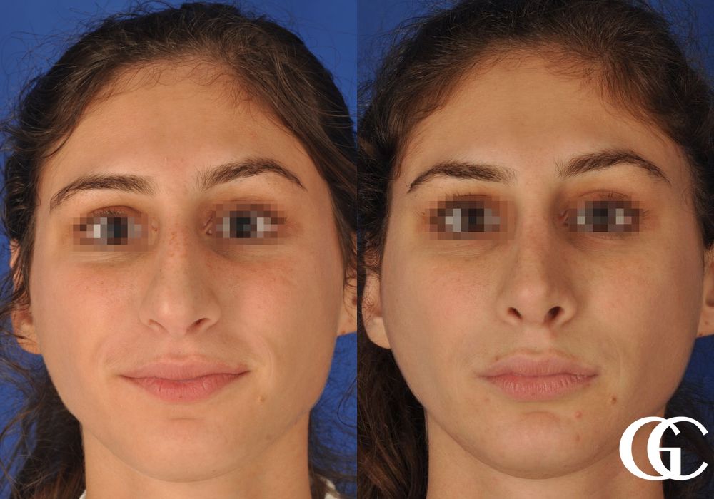 Rhinoplasty - Case 7428