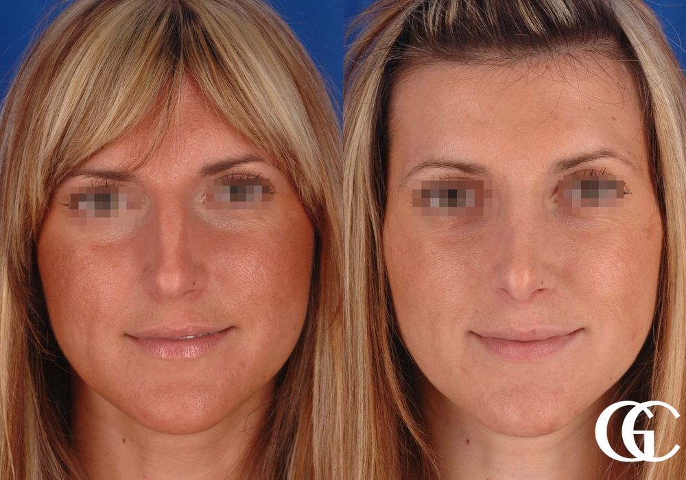 Rhinoplasty - Case 7426