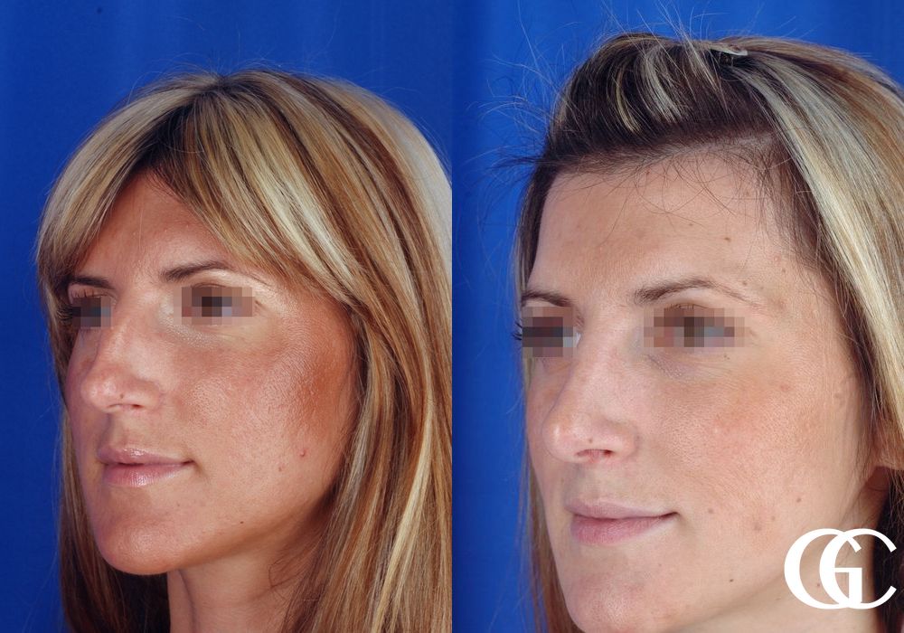 Rhinoplasty - Thumbnail 4