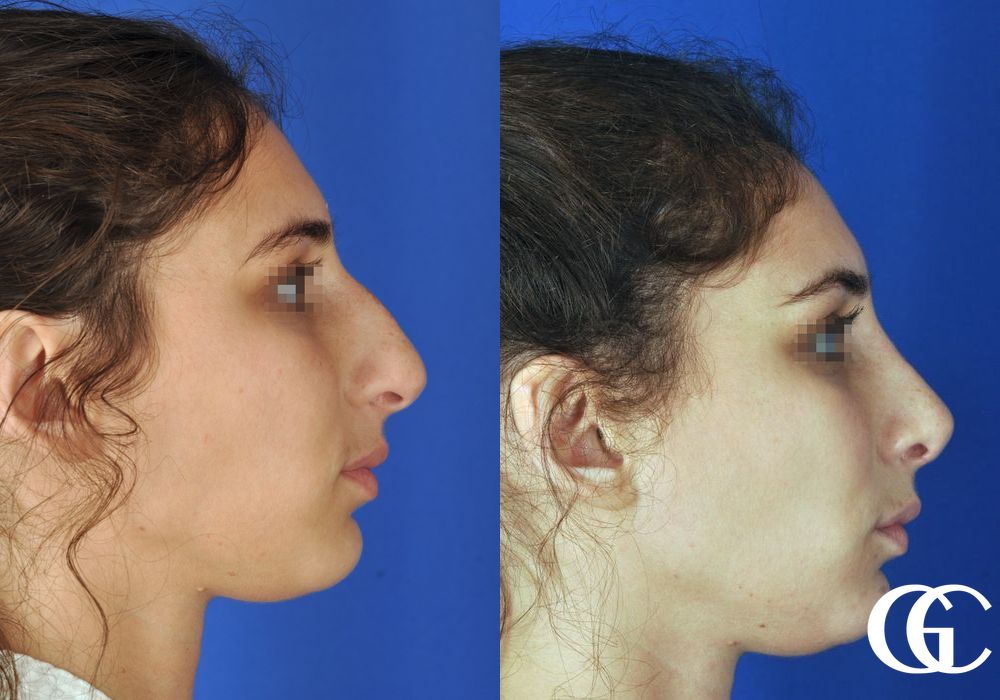 Rhinoplasty - Thumbnail 3